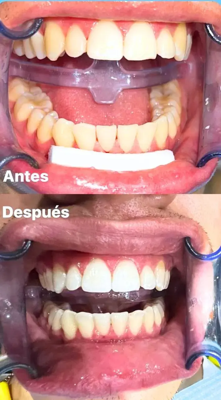 Blanqueamiento Dental