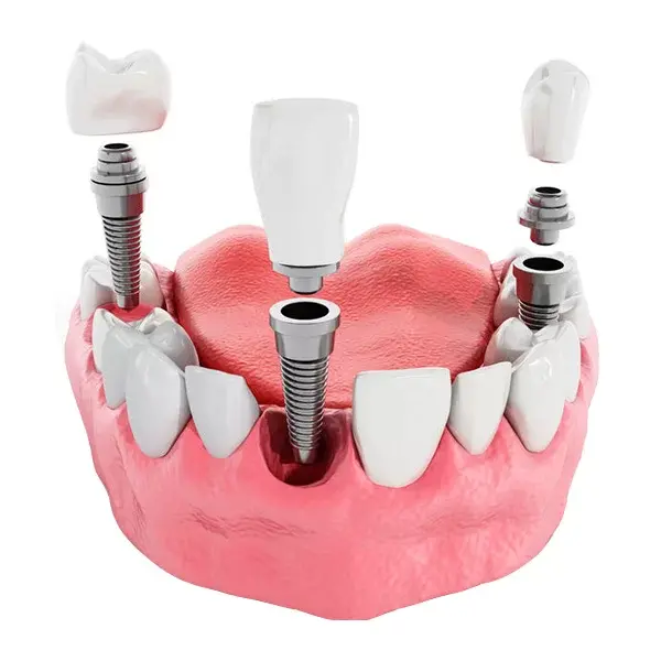 Implantes Dentales