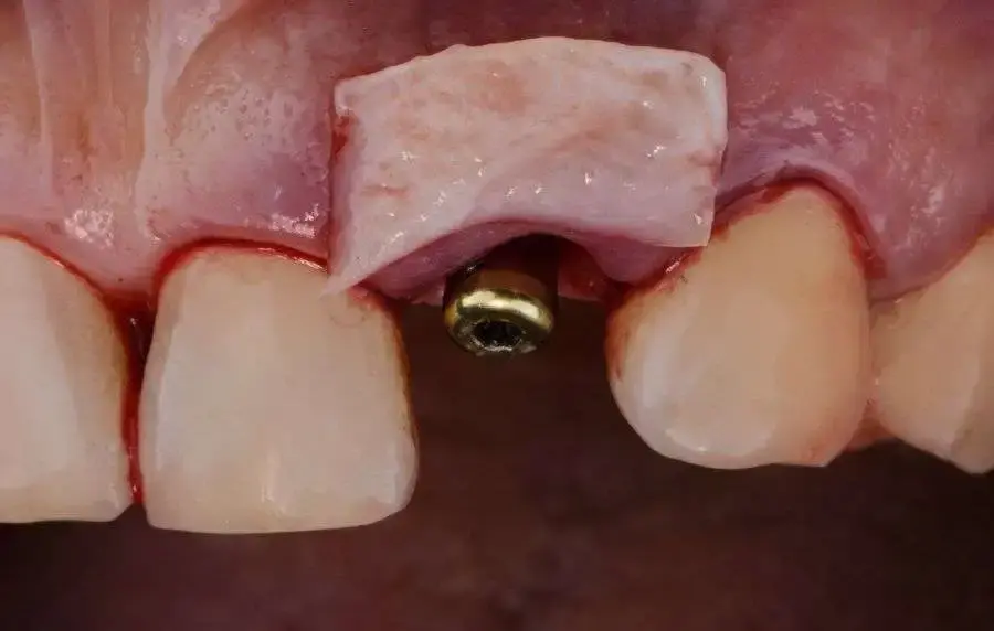Injerto de Hueso